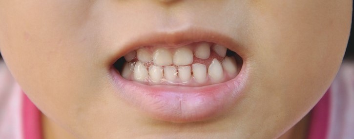 malocclusion dentaire 